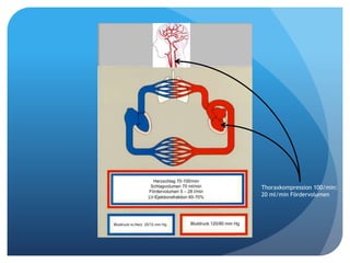 Thoraxkompression 100/min:
20 ml/min Fördervolumen
 