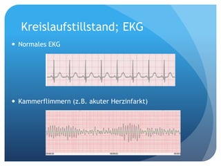 Kreislaufstillstand; EKG
 Normales EKG
 Kammerflimmern (z.B. akuter Herzinfarkt)
 