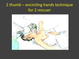 2 thumb – encircling hands technique
for 2 rescuer
 