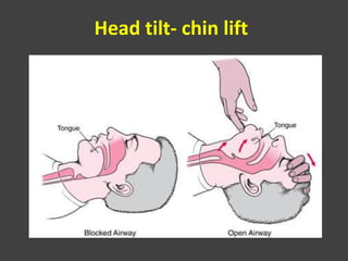 Head tilt- chin lift
 