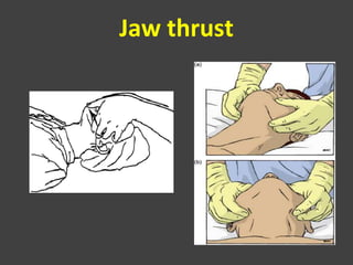 Jaw thrust
 
