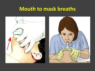 Mouth to mask breaths
 