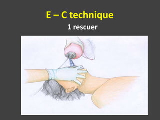 E – C technique
1 rescuer
 