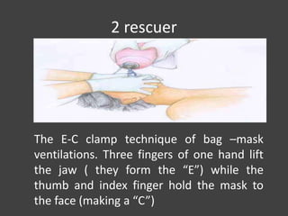 2 rescuer
The E-C clamp technique of bag –mask
ventilations. Three fingers of one hand lift
the jaw ( they form the “E”) while the
thumb and index finger hold the mask to
the face (making a “C”)
 
