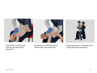 08/05/2026 16
Chest thrusts in an infant with
severe foreign-body airway
obstruction.
Back blows in an infant with severe
foreign-body airway obstruction.
Abdominal thrusts in a child with severe
foreign-body airway obstruction
 