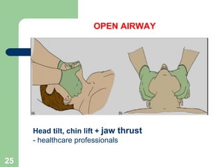 OPEN AIRWAY
Head tilt, chin lift + jaw thrust
- healthcare professionals
25
 
