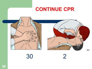 CONTINUE CPR
30 2
36
 