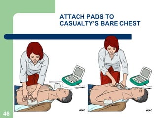 ATTACH PADS TO
CASUALTY’S BARE CHEST
46
 