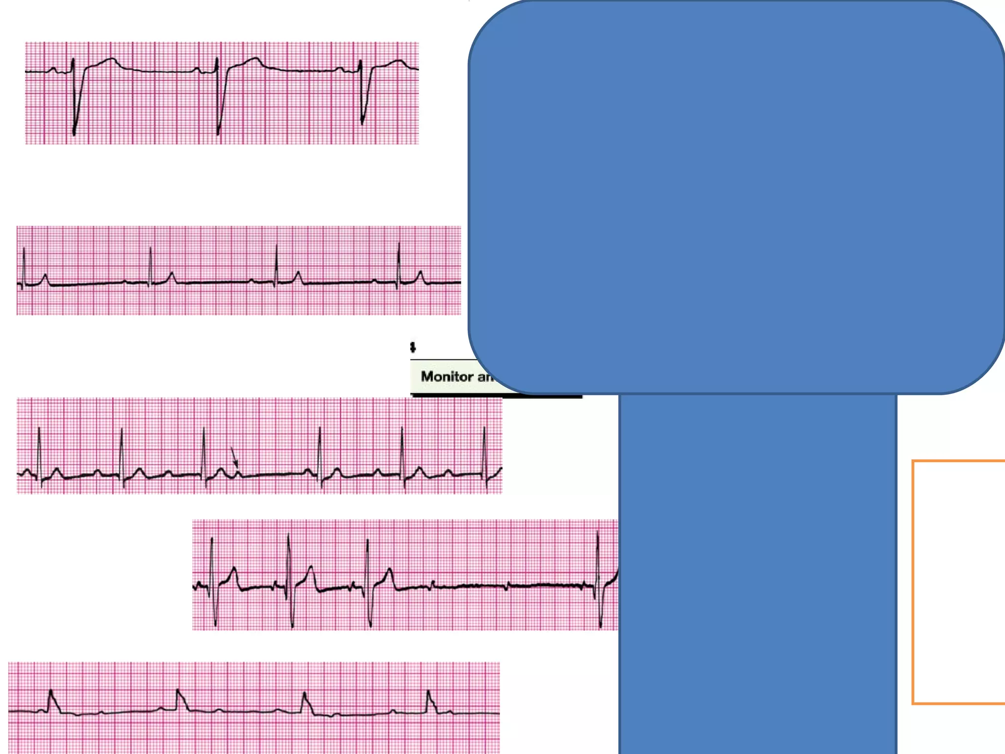 Bls and acls megacode --hui