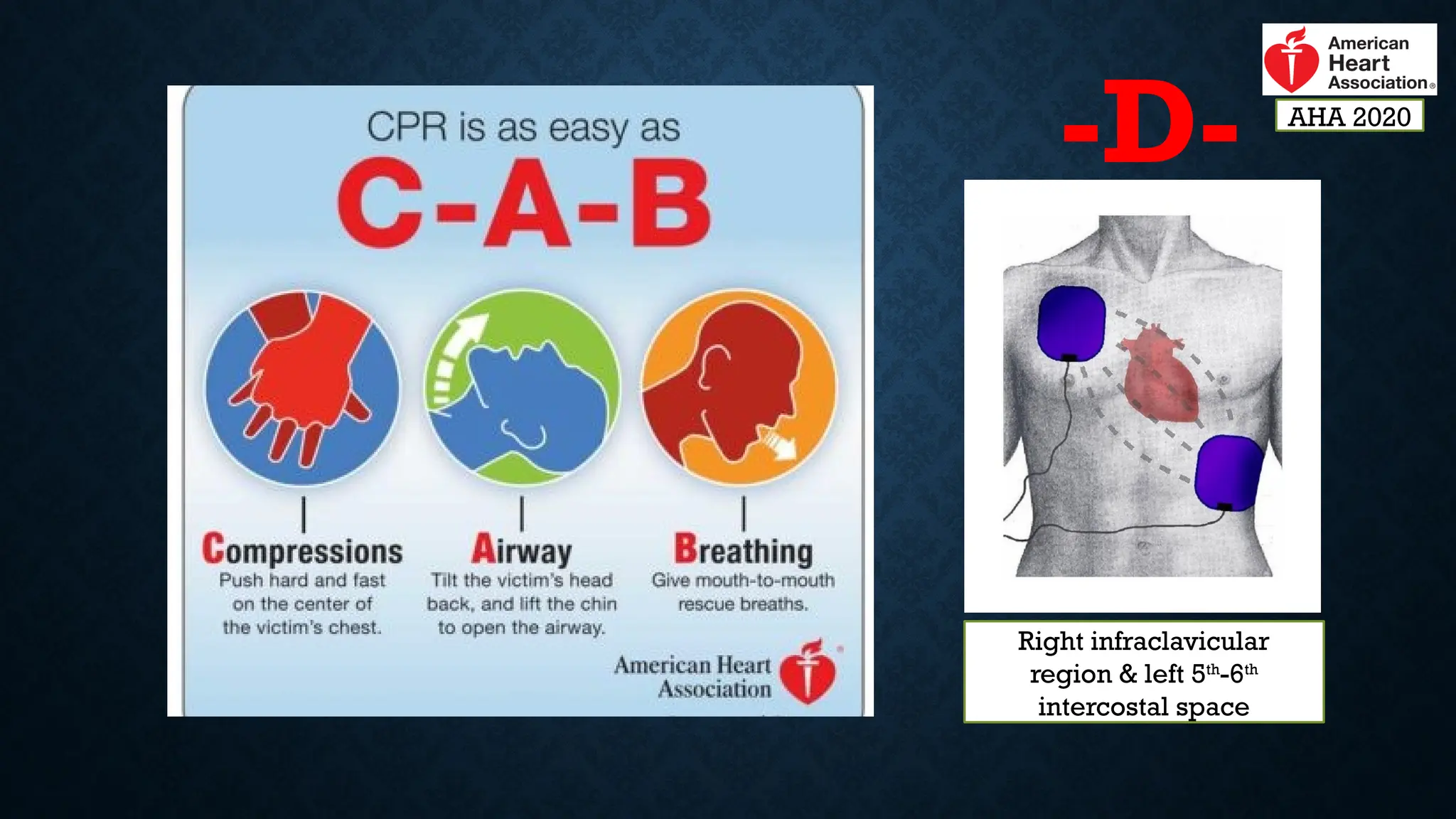 -D-
Right infraclavicular
region & left 5th
-6th
intercostal space
Right infraclavicular
region & left 5th
-6th
intercostal space
AHA 2020
 