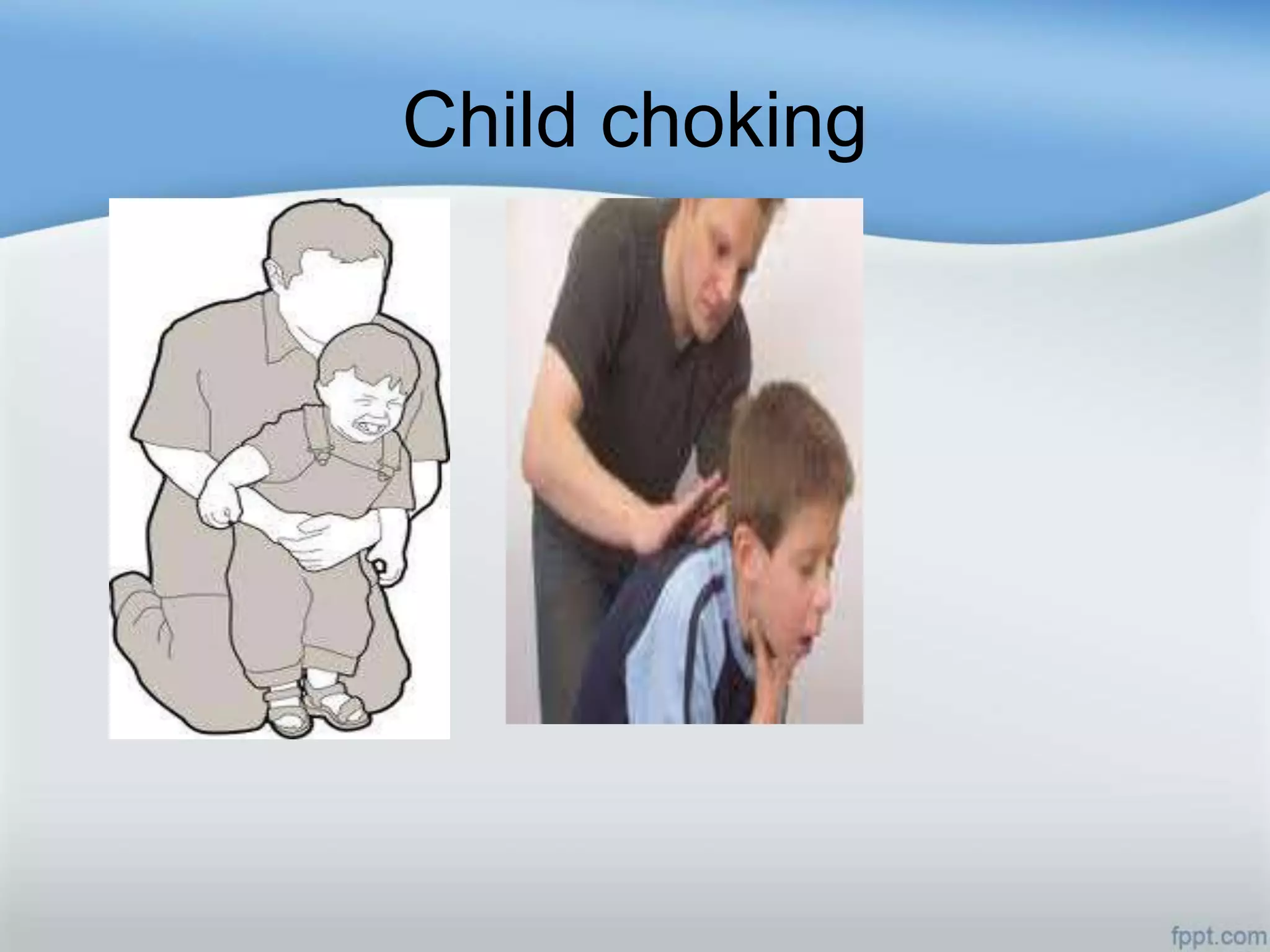 Child choking
 