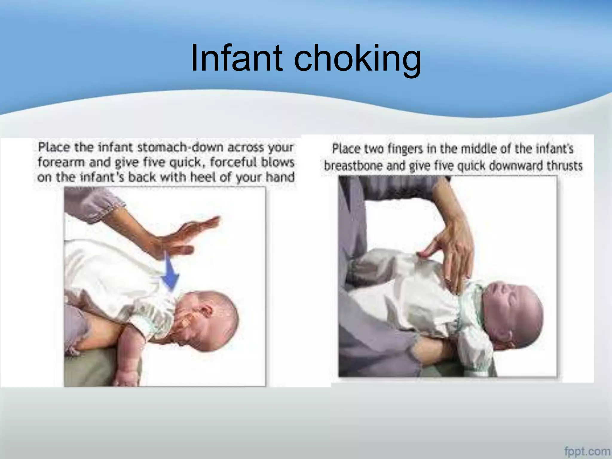Infant choking
 