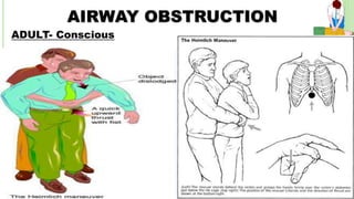 AIRWAY OBSTRUCTION
ADULT- Conscious
26-Jan-18
27
 
