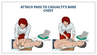 ATTACH PADS TO CASUALTY’S BARE
CHEST
 