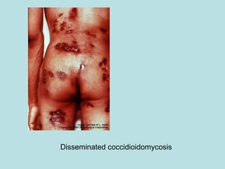 Disseminated coccidioidomycosis 