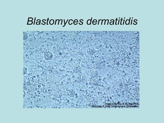 Blastomyces dermatitidis 