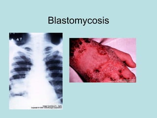 Blastomycosis 