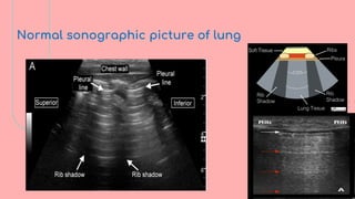Lev Protocol Pocus Bedside Ultrasound (BLUE Protocol): Advanced POCUS in Critical Care | PDF