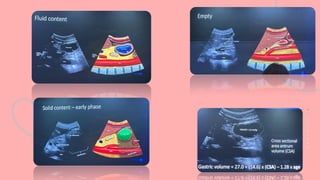 Bedside Ultrasound (BLUE Protocol): Advanced POCUS in Critical Care | PDF