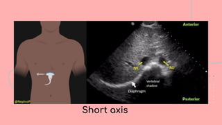 Bedside Ultrasound (BLUE Protocol): Advanced POCUS in Critical Care | PDF