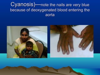 Cyanosis)—Cyanosis)—note the nails are very bluenote the nails are very blue
because of deoxygenated blood entering thebec...