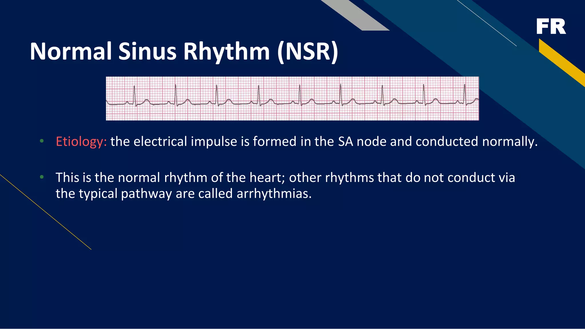FR
Normal Sinus Rhythm (NSR)
• Etiology: the electrical impulse is formed in the SA node and conducted normally.
• This is the normal rhythm of the heart; other rhythms that do not conduct via
the typical pathway are called arrhythmias.
 