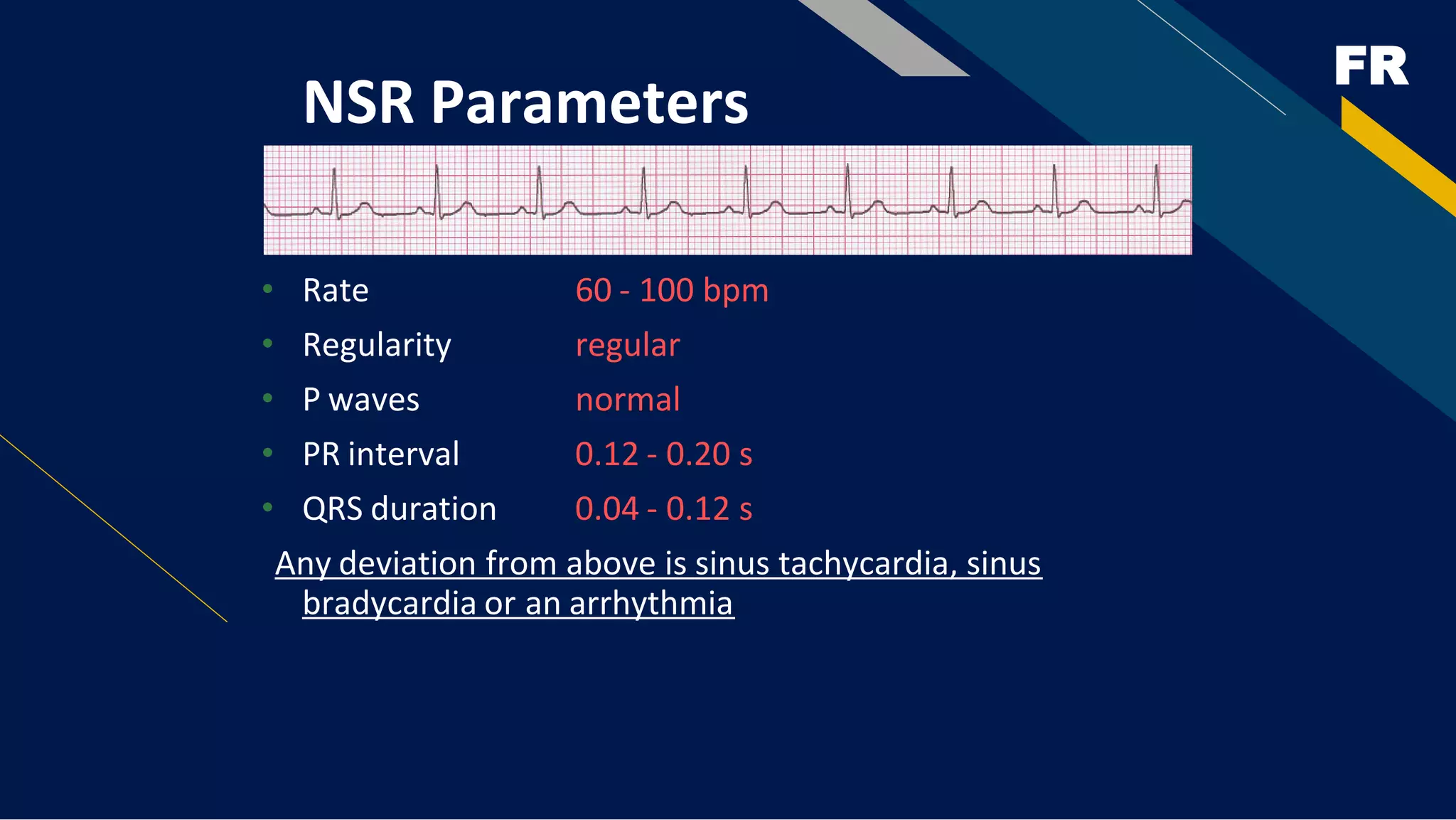 FR
NSR Parameters
• Rate 60 - 100 bpm
• Regularity regular
• P waves normal
• PR interval 0.12 - 0.20 s
• QRS duration 0.04 - 0.12 s
Any deviation from above is sinus tachycardia, sinus
bradycardia or an arrhythmia
 