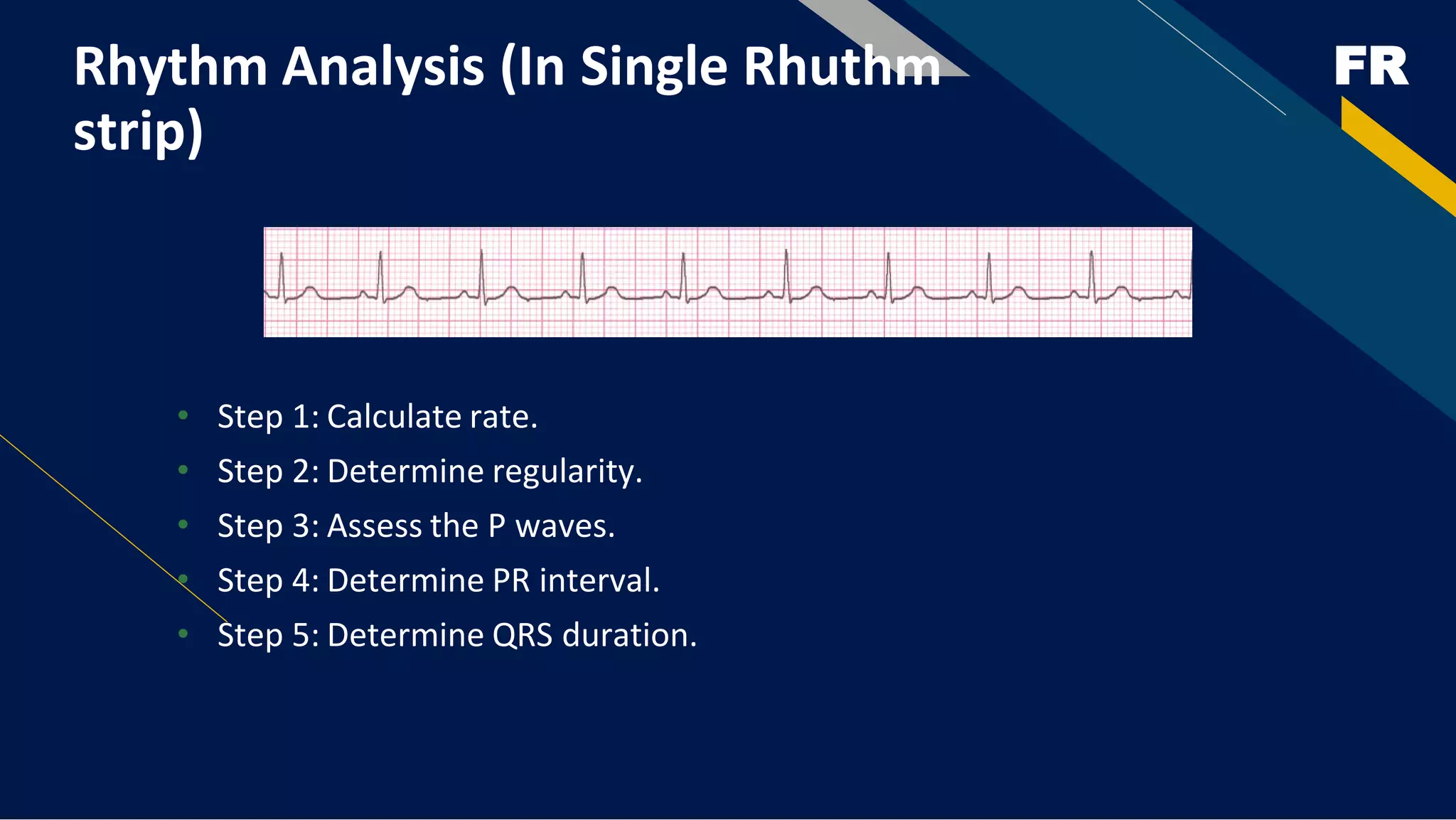 FR
Rhythm Analysis (In Single Rhuthm
strip)
• Step 1: Calculate rate.
• Step 2: Determine regularity.
• Step 3: Assess the P waves.
• Step 4: Determine PR interval.
• Step 5: Determine QRS duration.
 