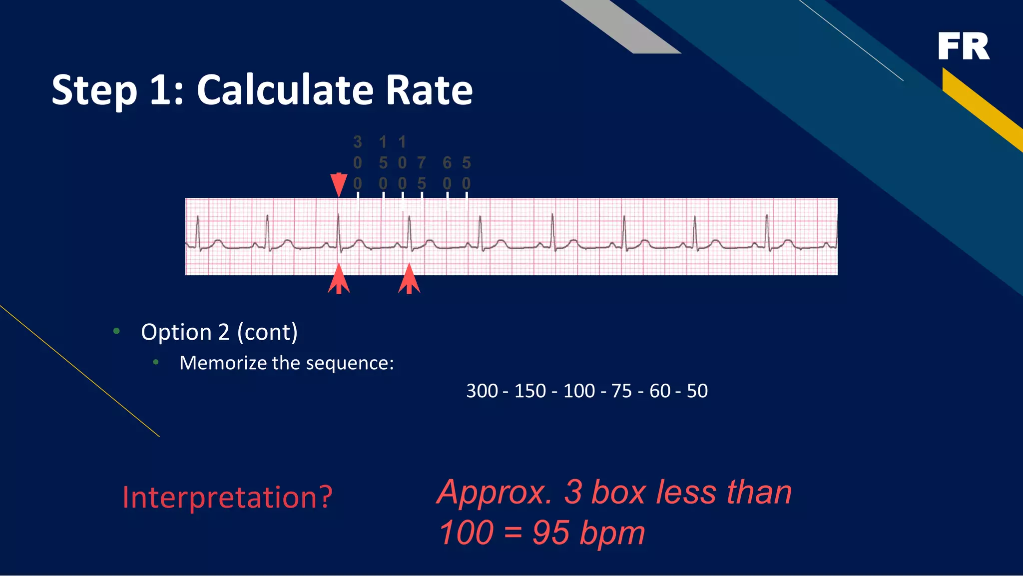 FR
Step 1: Calculate Rate
• Option 2 (cont)
• Memorize the sequence:
300 - 150 - 100 - 75 - 60 - 50
Interpretation?
3
0
0
1
5
0
1
0
0
7
5
6
0
5
0
Approx. 3 box less than
100 = 95 bpm
 