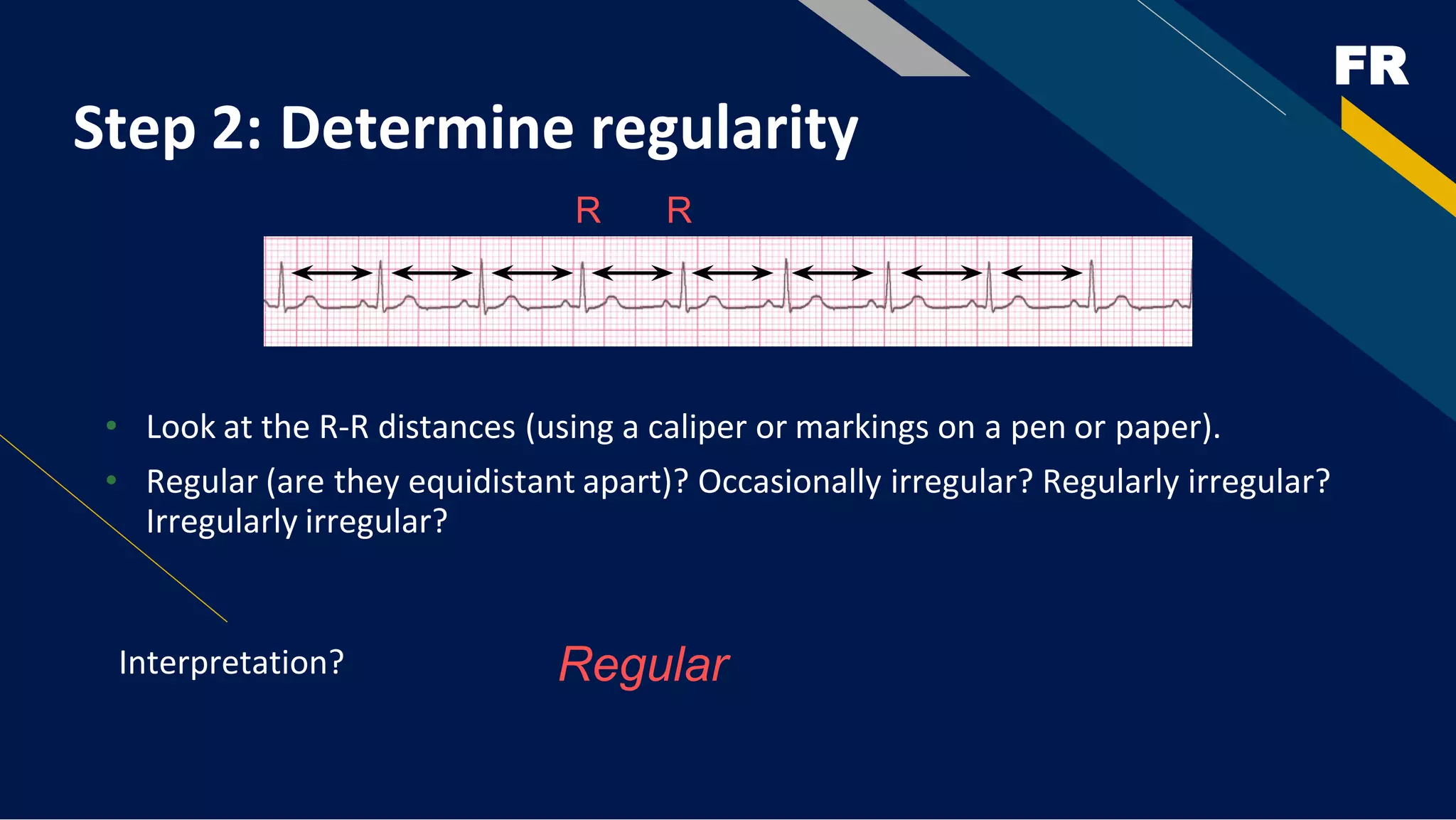 FR
Step 2: Determine regularity
• Look at the R-R distances (using a caliper or markings on a pen or paper).
• Regular (are they equidistant apart)? Occasionally irregular? Regularly irregular?
Irregularly irregular?
Interpretation? Regular
R R
 