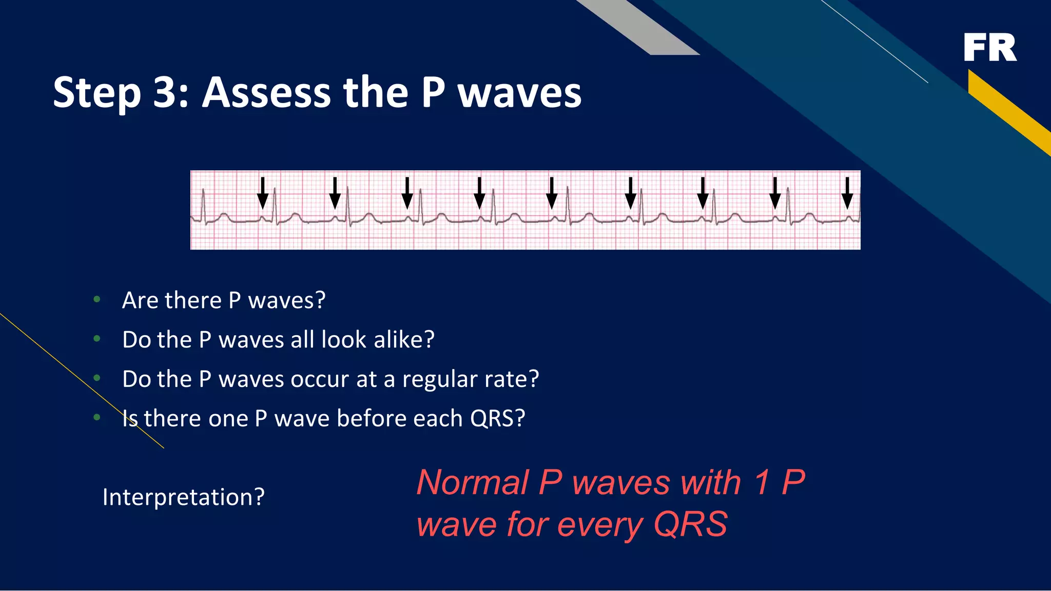 FR
Step 3: Assess the P waves
• Are there P waves?
• Do the P waves all look alike?
• Do the P waves occur at a regular rate?
• Is there one P wave before each QRS?
Interpretation? Normal P waves with 1 P
wave for every QRS
 