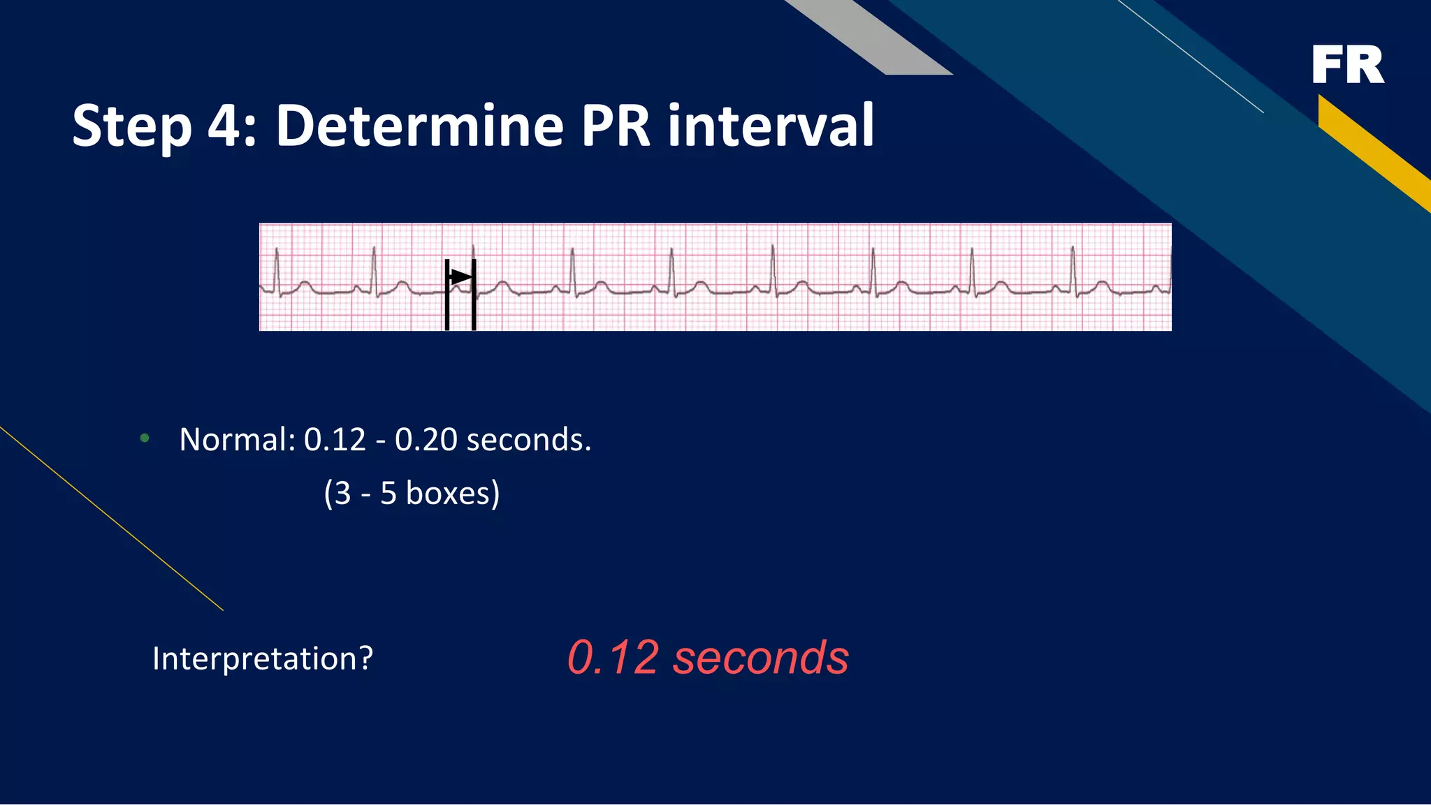 FR
Step 4: Determine PR interval
• Normal: 0.12 - 0.20 seconds.
(3 - 5 boxes)
Interpretation? 0.12 seconds
 