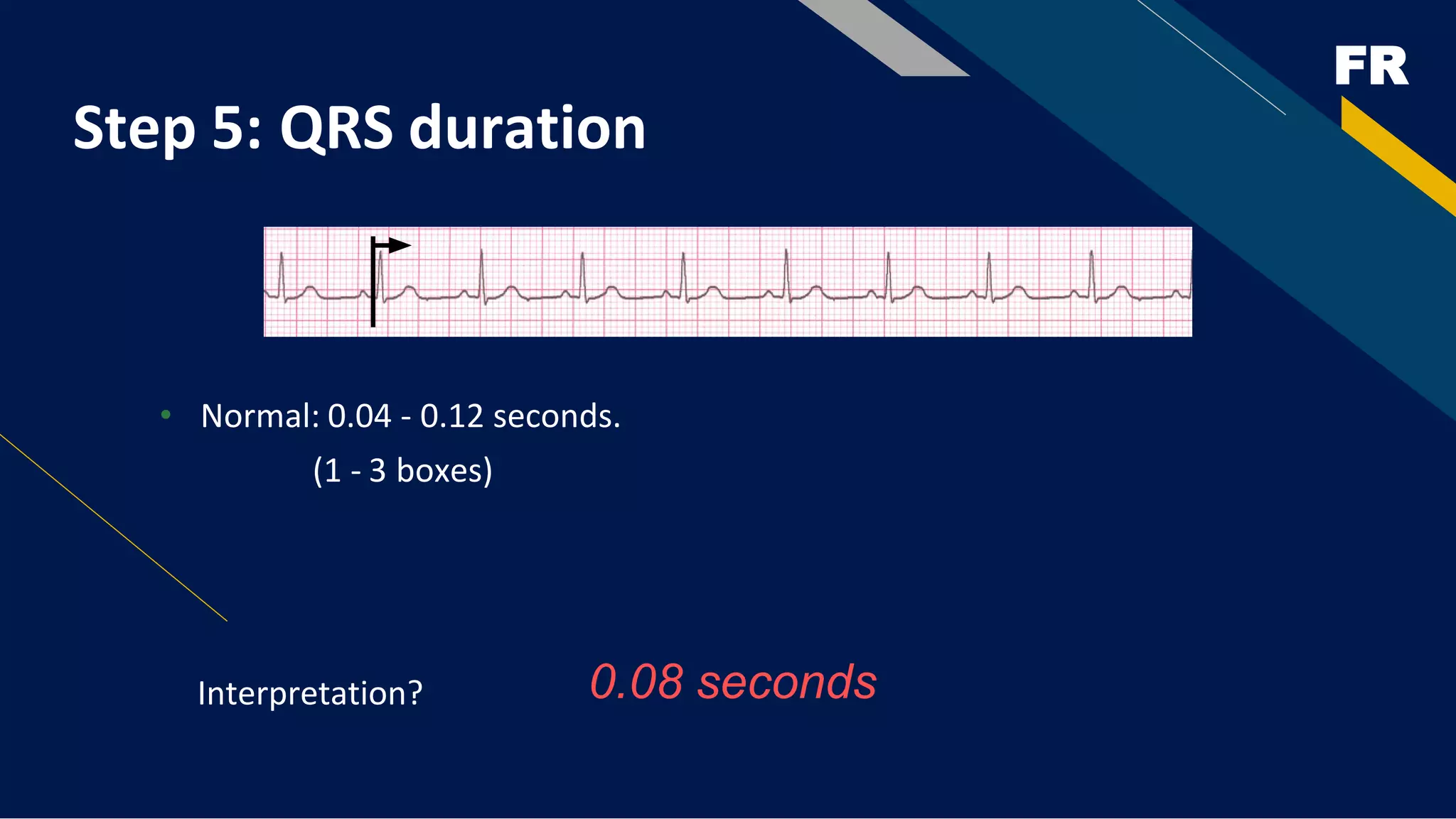 FR
Step 5: QRS duration
• Normal: 0.04 - 0.12 seconds.
(1 - 3 boxes)
Interpretation? 0.08 seconds
 