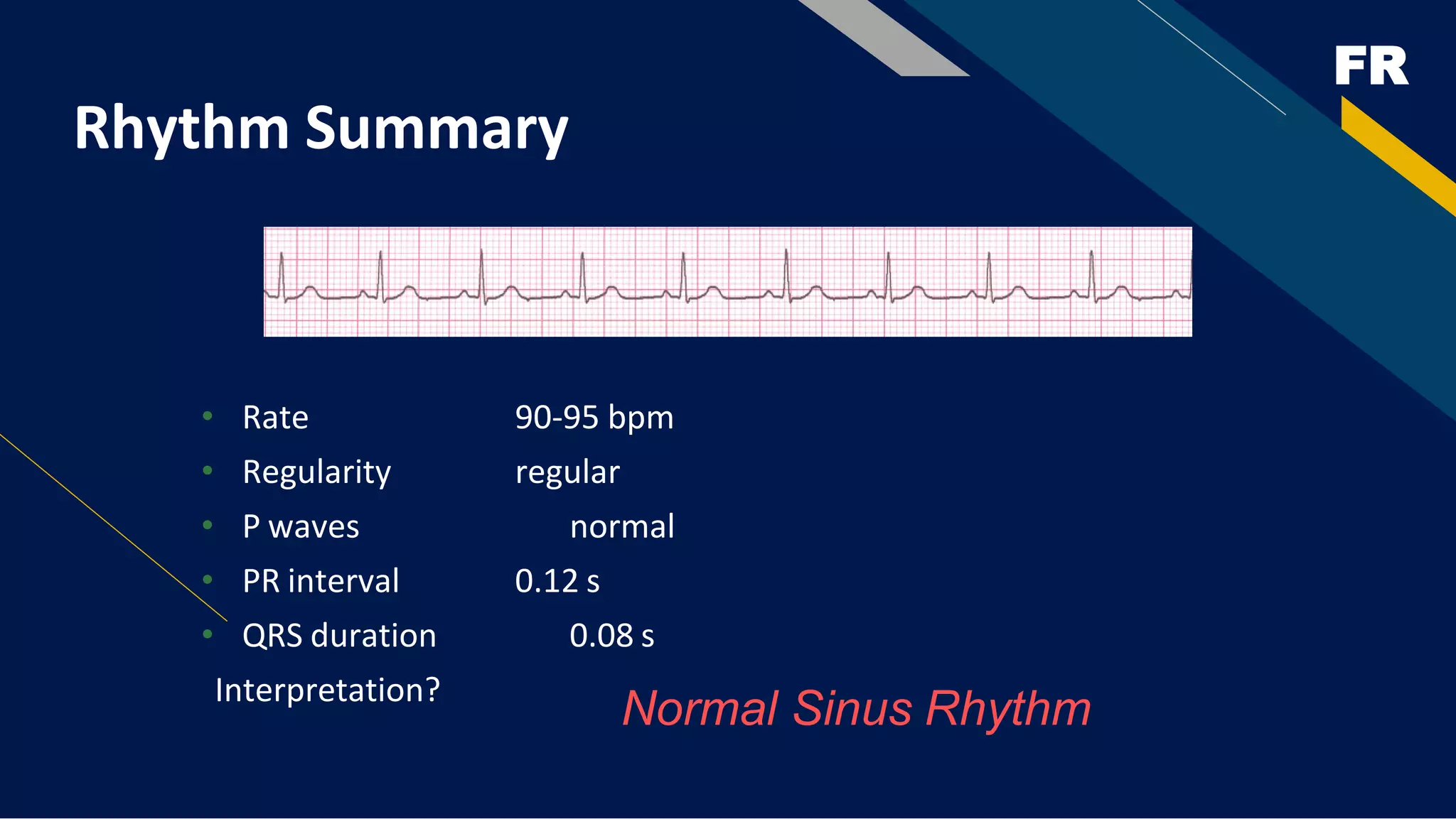 FR
Rhythm Summary
• Rate 90-95 bpm
• Regularity regular
• P waves normal
• PR interval 0.12 s
• QRS duration 0.08 s
Interpretation?
Normal Sinus Rhythm
 