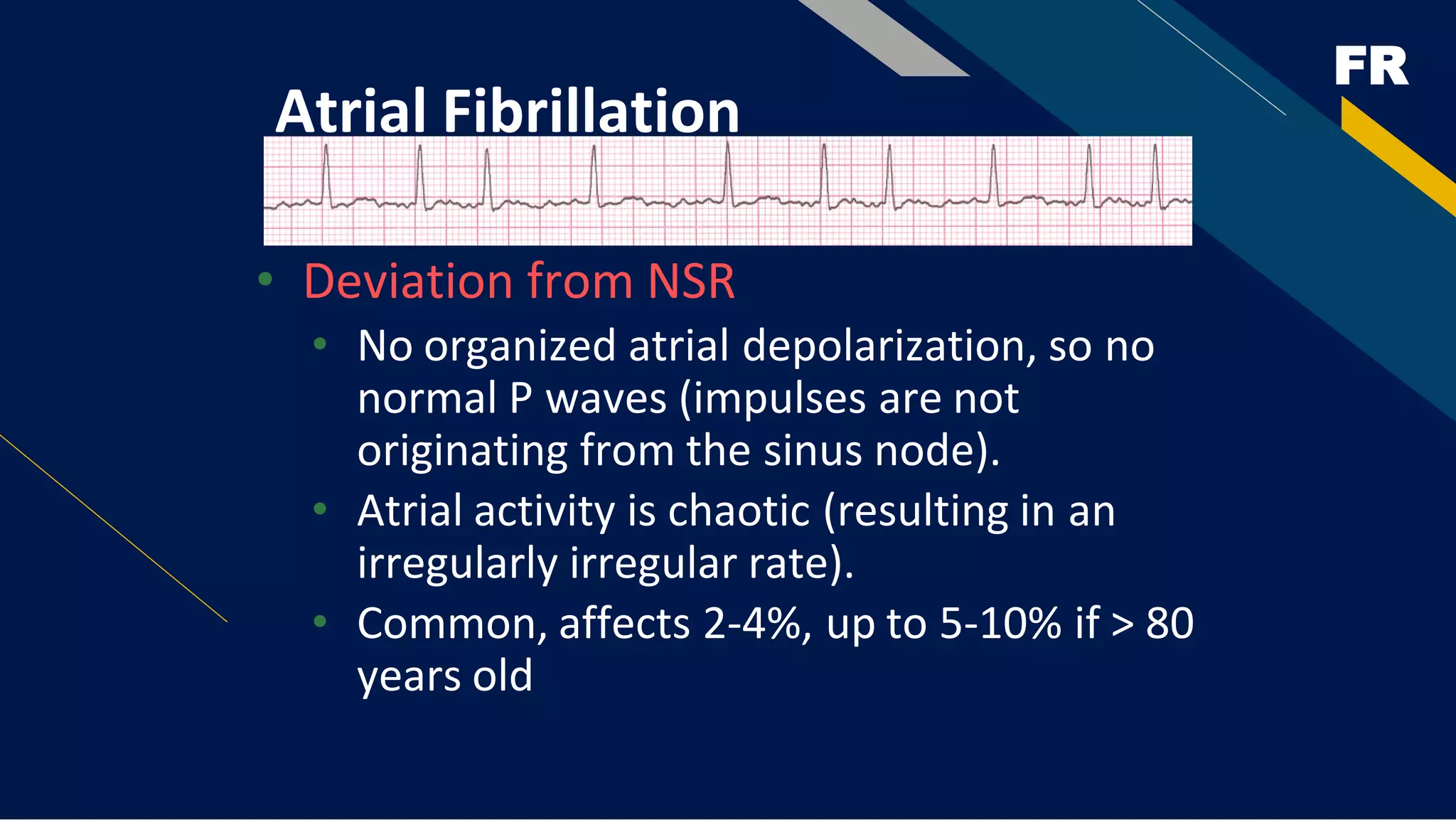 FR
Atrial Fibrillation
• Deviation from NSR
• No organized atrial depolarization, so no
normal P waves (impulses are not
originating from the sinus node).
• Atrial activity is chaotic (resulting in an
irregularly irregular rate).
• Common, affects 2-4%, up to 5-10% if > 80
years old
 