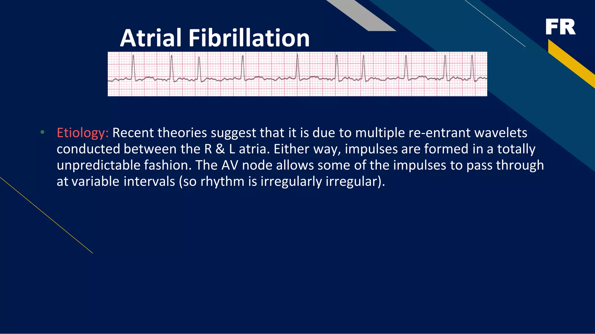 FR
Atrial Fibrillation
• Etiology: Recent theories suggest that it is due to multiple re-entrant wavelets
conducted between the R & L atria. Either way, impulses are formed in a totally
unpredictable fashion. The AV node allows some of the impulses to pass through
at variable intervals (so rhythm is irregularly irregular).
 
