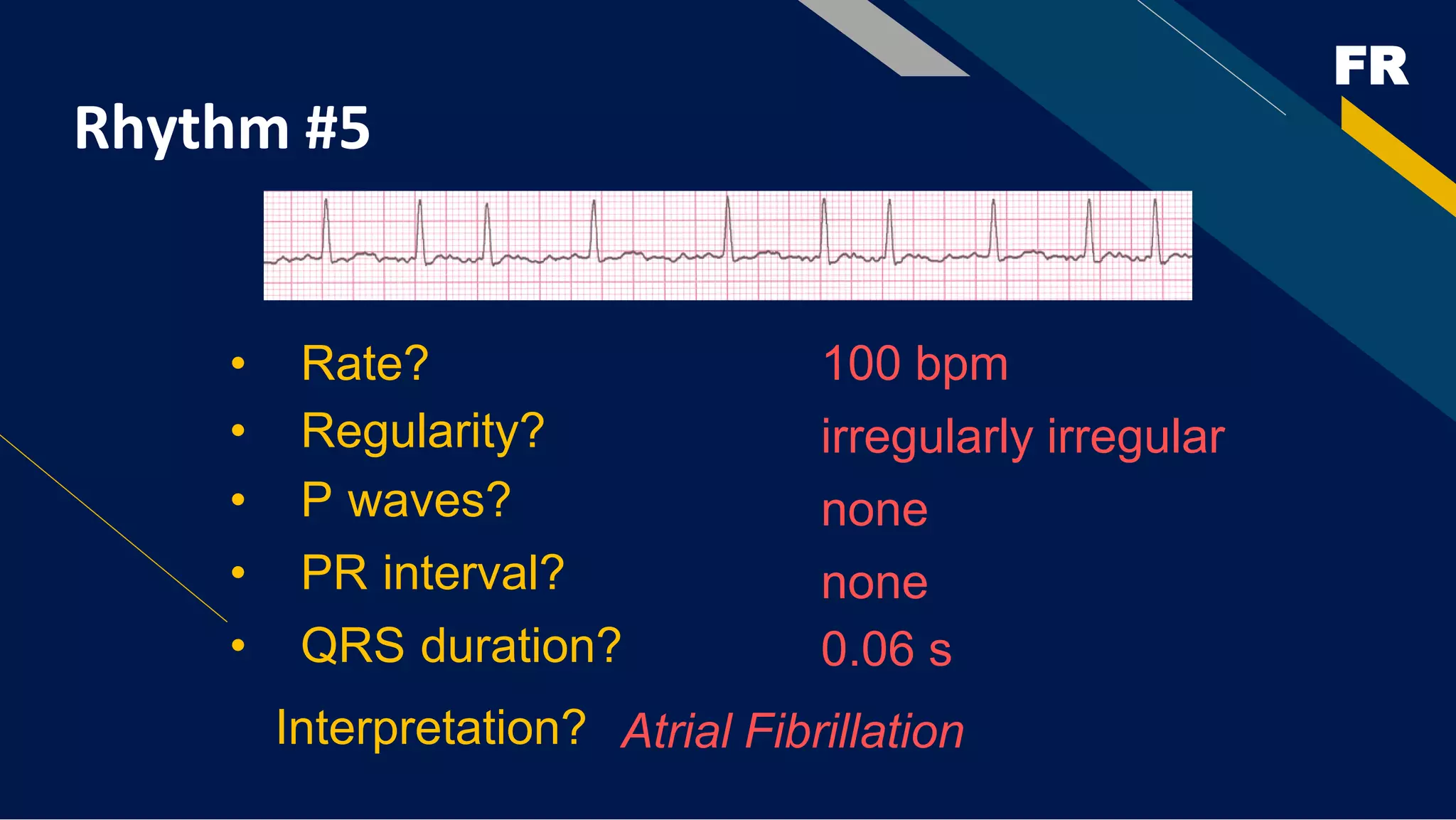 FR
Rhythm #5
100 bpm
• Rate?
• Regularity? irregularly irregular
none
0.06 s
• P waves?
• PR interval? none
• QRS duration?
Interpretation? Atrial Fibrillation
 