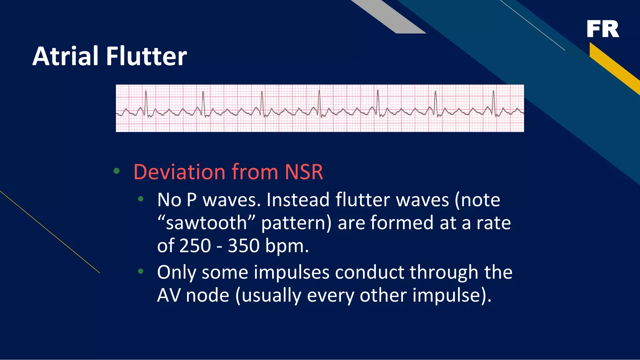 FR
Atrial Flutter
• Deviation from NSR
• No P waves. Instead flutter waves (note
“sawtooth” pattern) are formed at a rate
of 250 - 350 bpm.
• Only some impulses conduct through the
AV node (usually every other impulse).
 