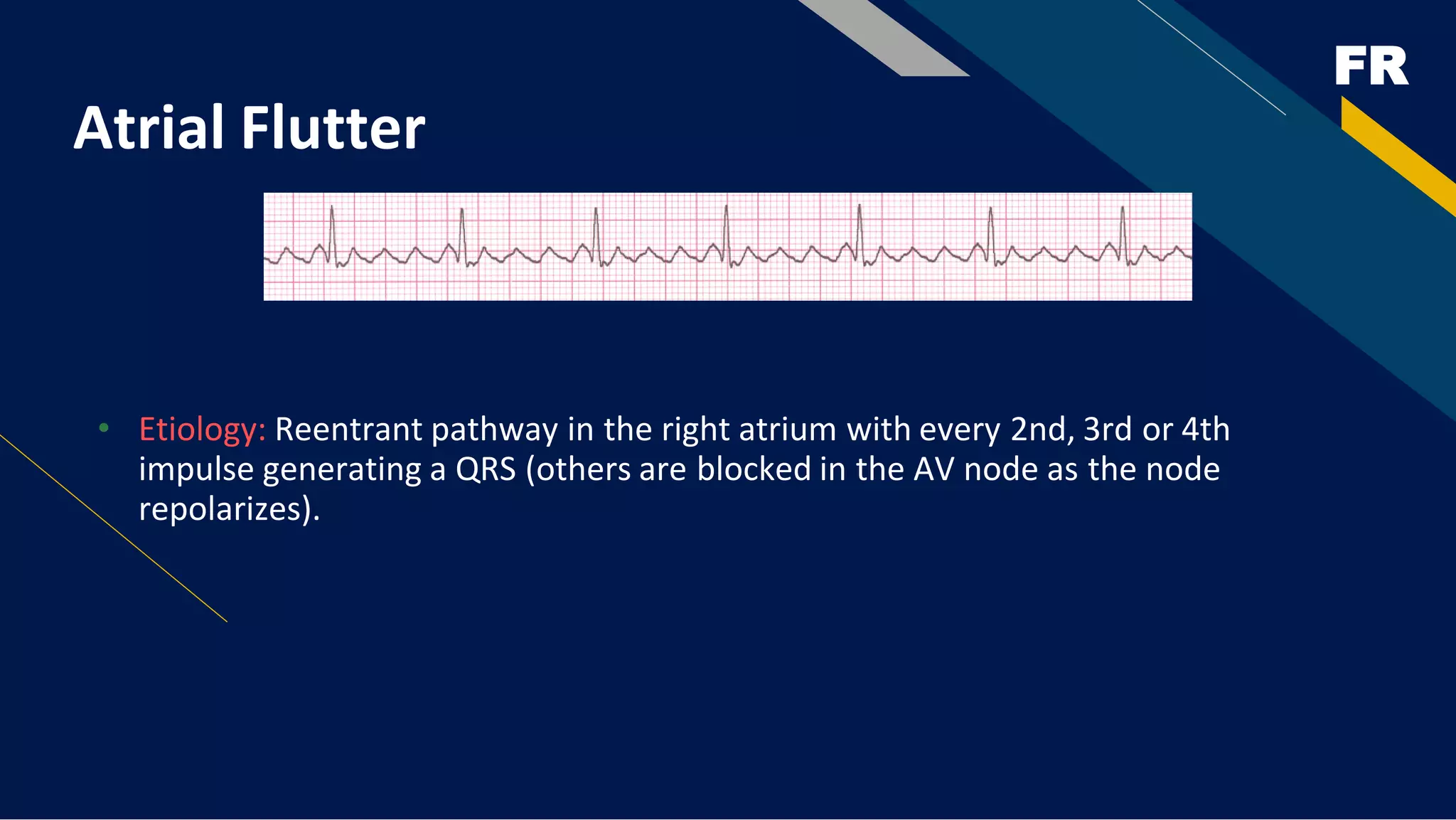 FR
Atrial Flutter
• Etiology: Reentrant pathway in the right atrium with every 2nd, 3rd or 4th
impulse generating a QRS (others are blocked in the AV node as the node
repolarizes).
 