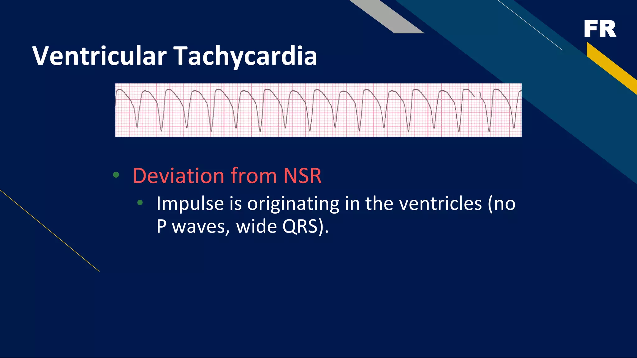 FR
Ventricular Tachycardia
• Deviation from NSR
• Impulse is originating in the ventricles (no
P waves, wide QRS).
 