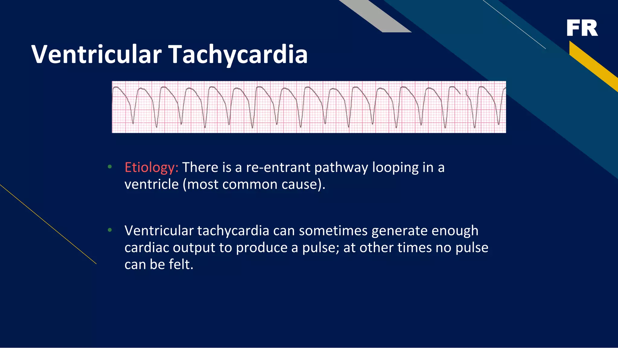 FR
Ventricular Tachycardia
• Etiology: There is a re-entrant pathway looping in a
ventricle (most common cause).
• Ventricular tachycardia can sometimes generate enough
cardiac output to produce a pulse; at other times no pulse
can be felt.
 