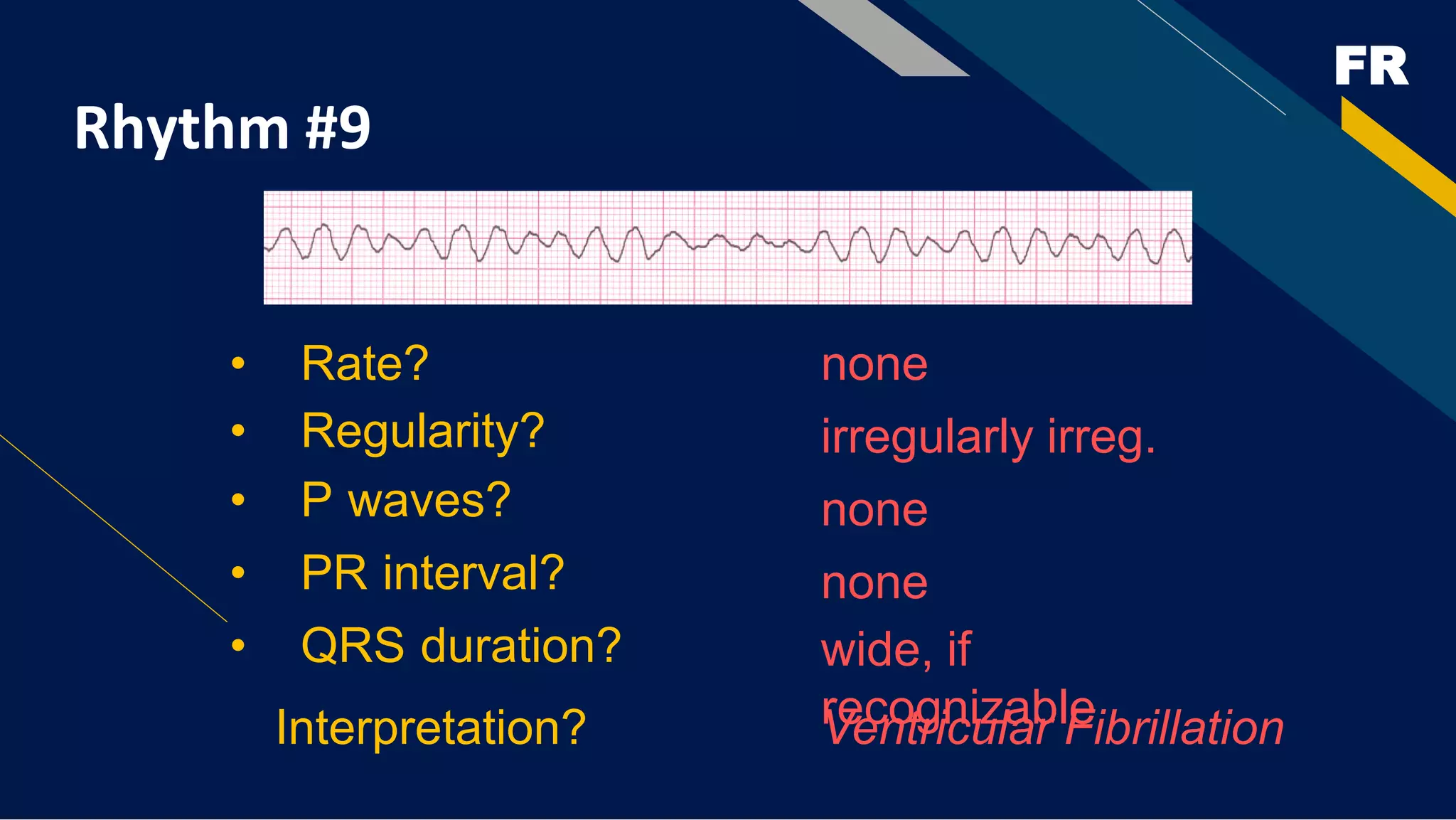 FR
Rhythm #9
none
• Rate?
• Regularity? irregularly irreg.
none
wide, if
recognizable
• P waves?
• PR interval? none
• QRS duration?
Interpretation? Ventricular Fibrillation
 