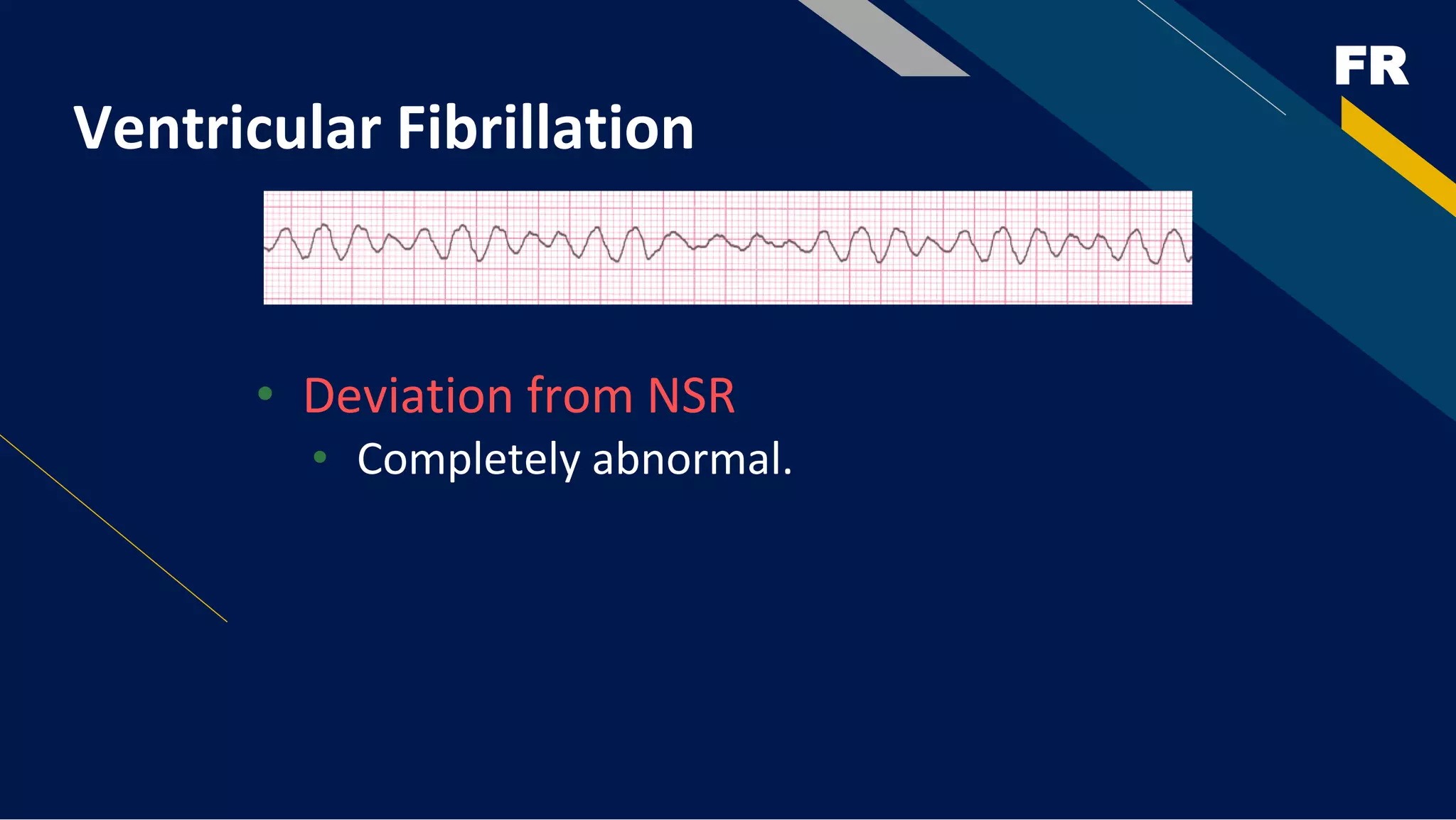 FR
Ventricular Fibrillation
• Deviation from NSR
• Completely abnormal.
 
