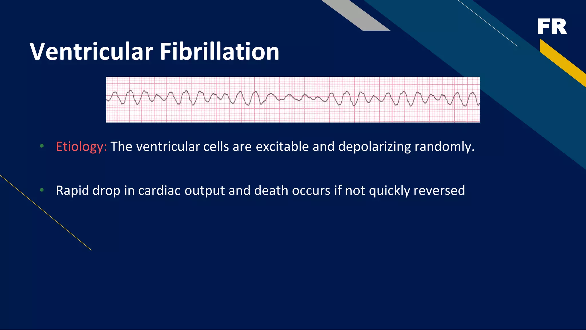 FR
Ventricular Fibrillation
• Etiology: The ventricular cells are excitable and depolarizing randomly.
• Rapid drop in cardiac output and death occurs if not quickly reversed
 