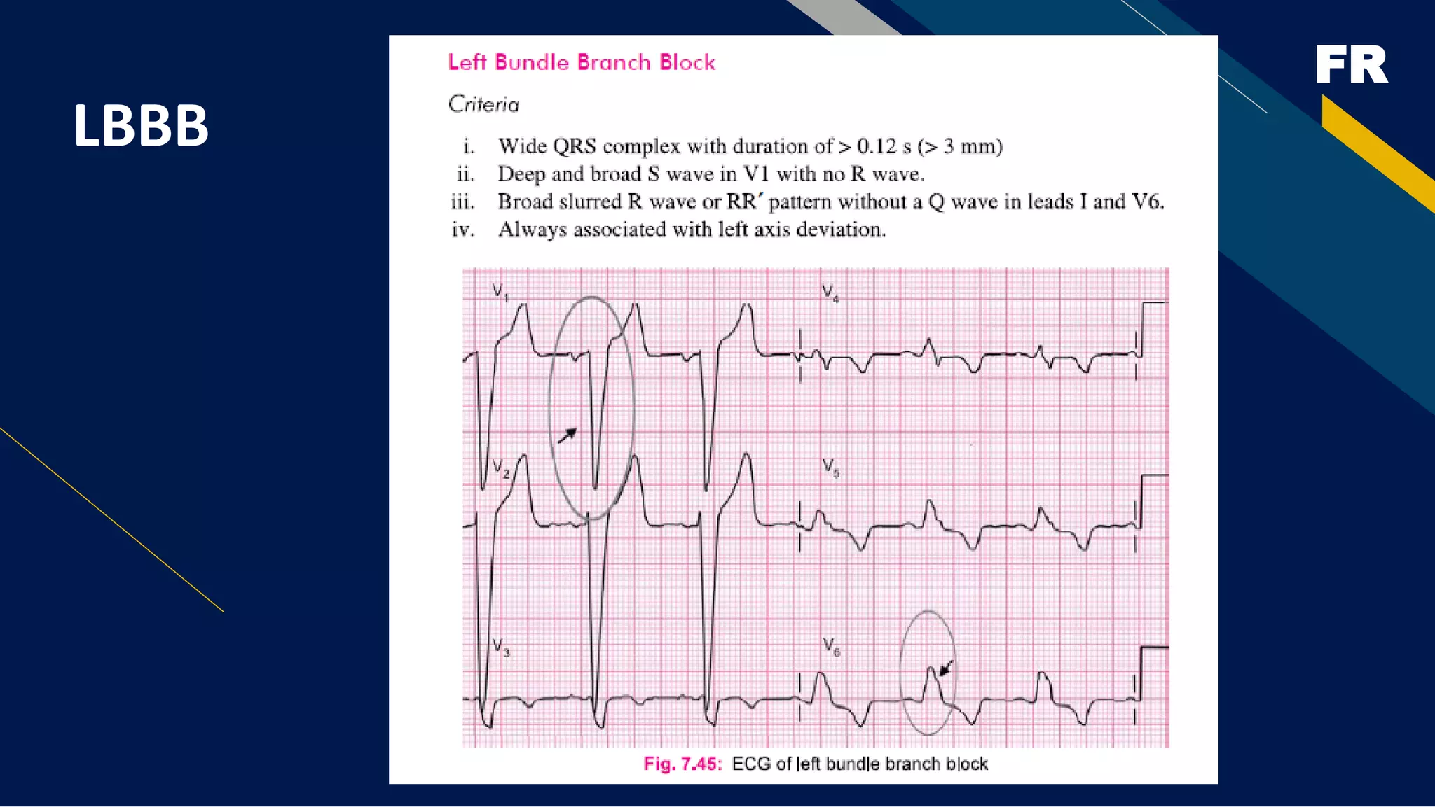 FR
LBBB
 