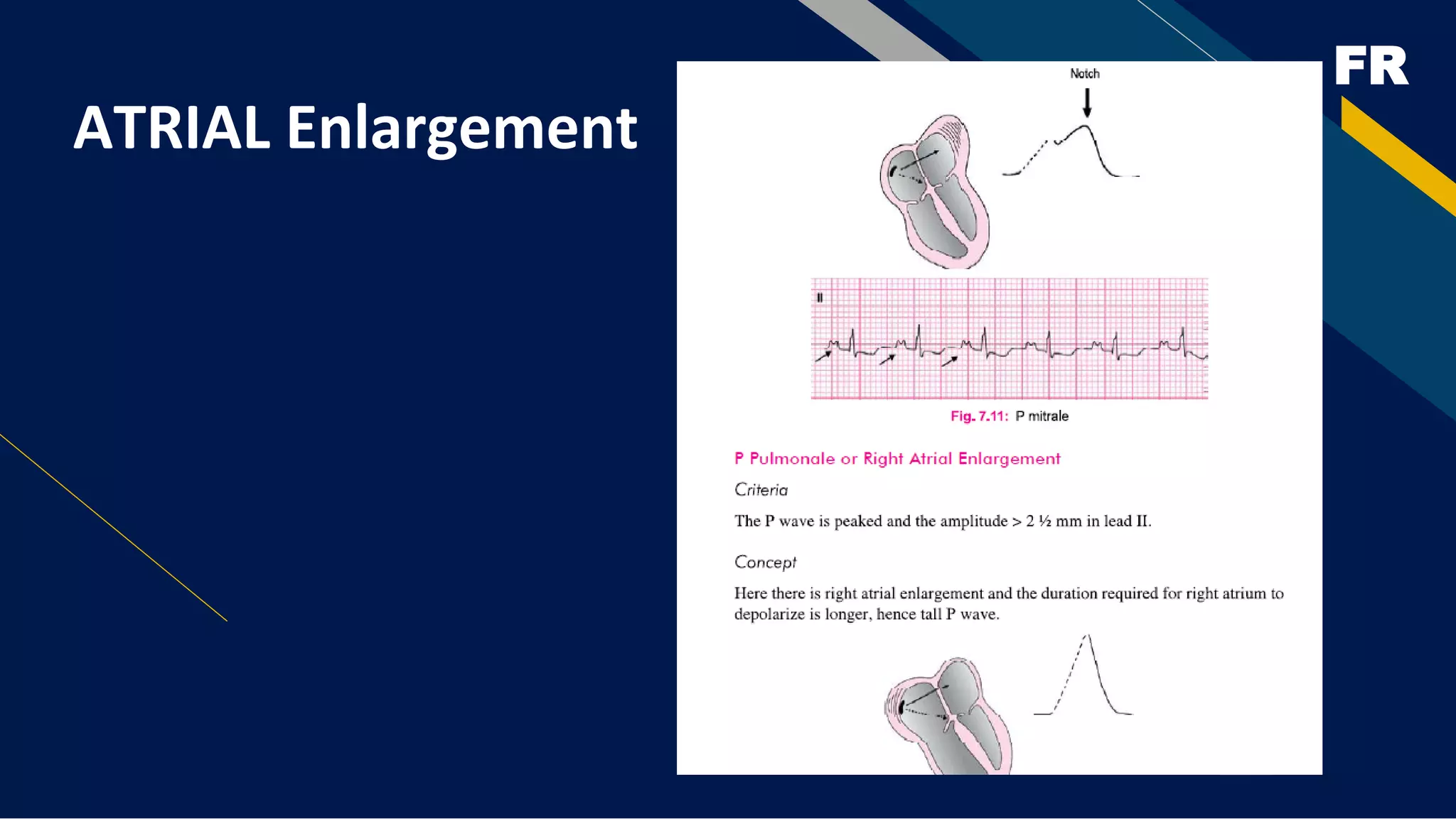 FR
ATRIAL Enlargement
 