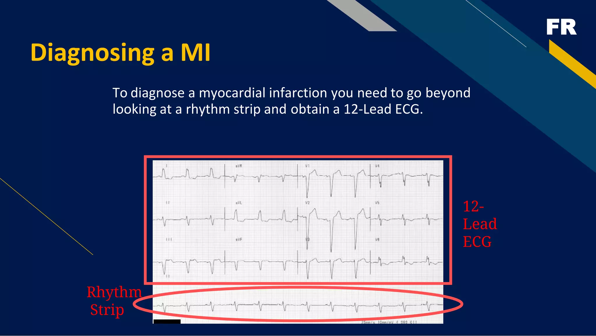 FR
Diagnosing a MI
To diagnose a myocardial infarction you need to go beyond
looking at a rhythm strip and obtain a 12-Lead ECG.
Rhythm
Strip
12-
Lead
ECG
 