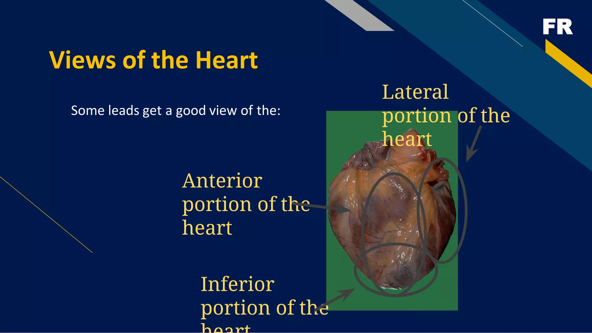 FR
Views of the Heart
Some leads get a good view of the:
Anterior
portion of the
heart
Lateral
portion of the
heart
Inferior
portion of the
 