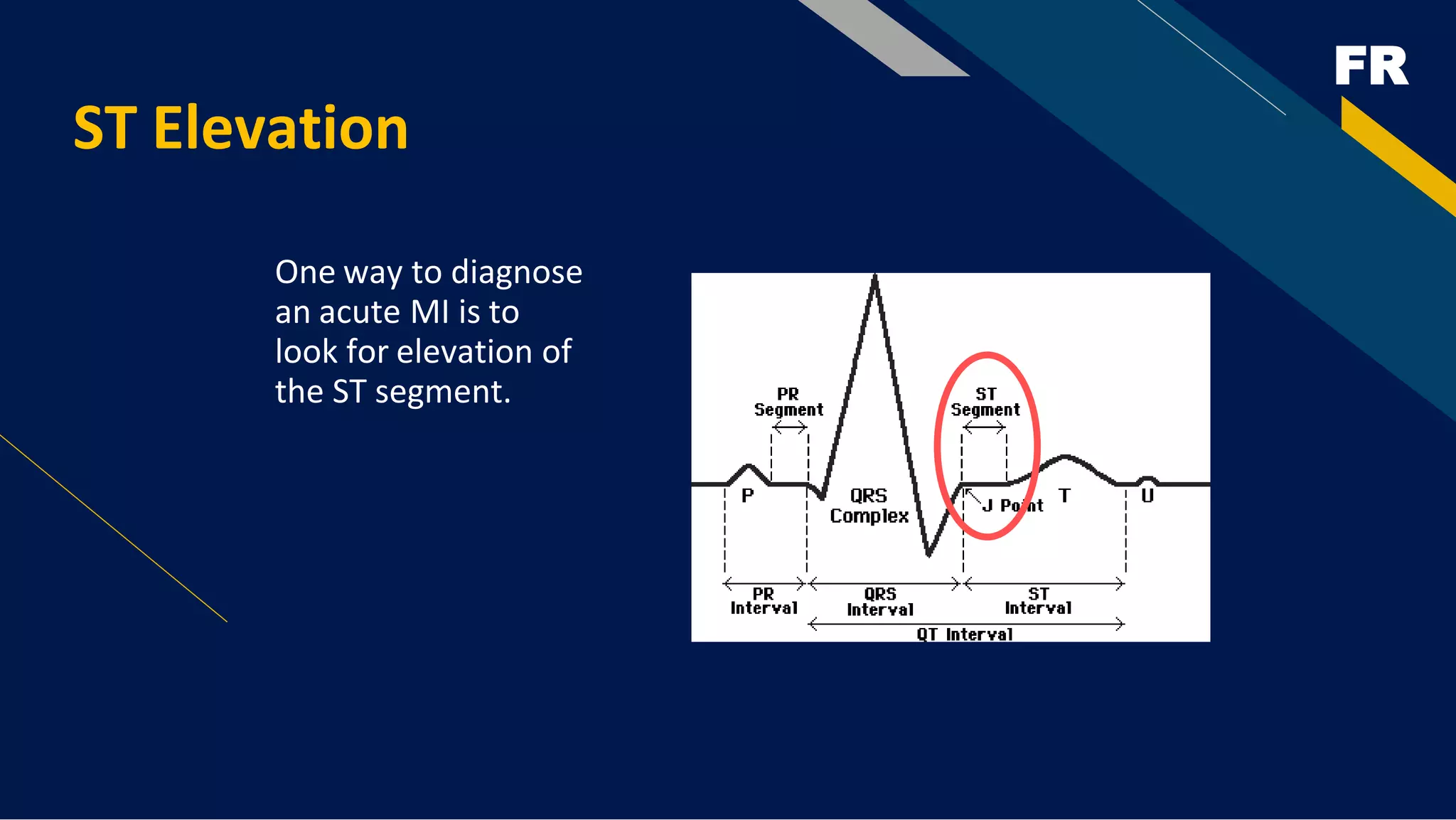 FR
ST Elevation
One way to diagnose
an acute MI is to
look for elevation of
the ST segment.
 