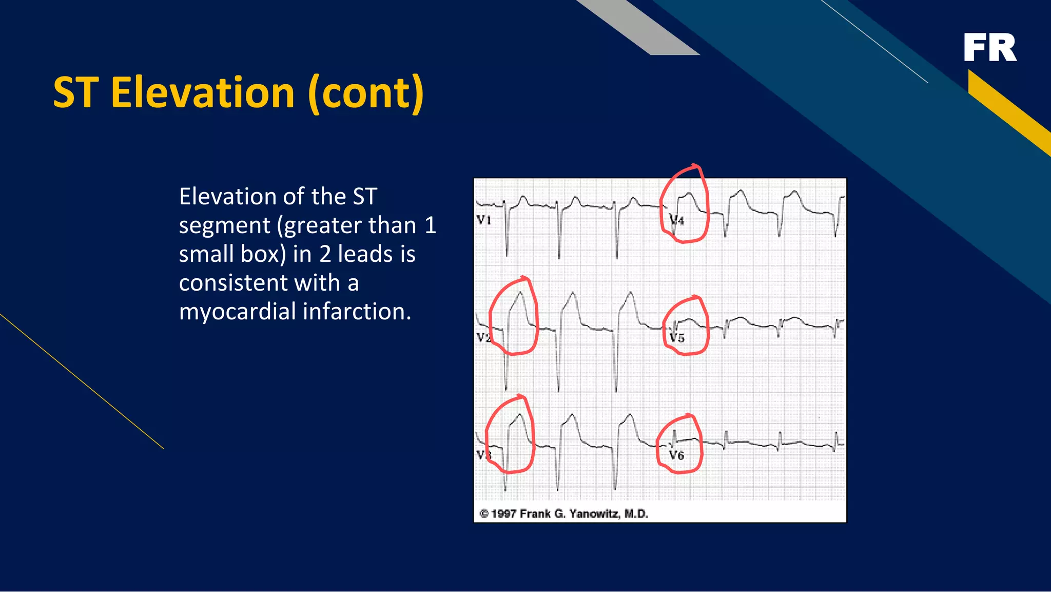 FR
ST Elevation (cont)
Elevation of the ST
segment (greater than 1
small box) in 2 leads is
consistent with a
myocardial infarction.
 
